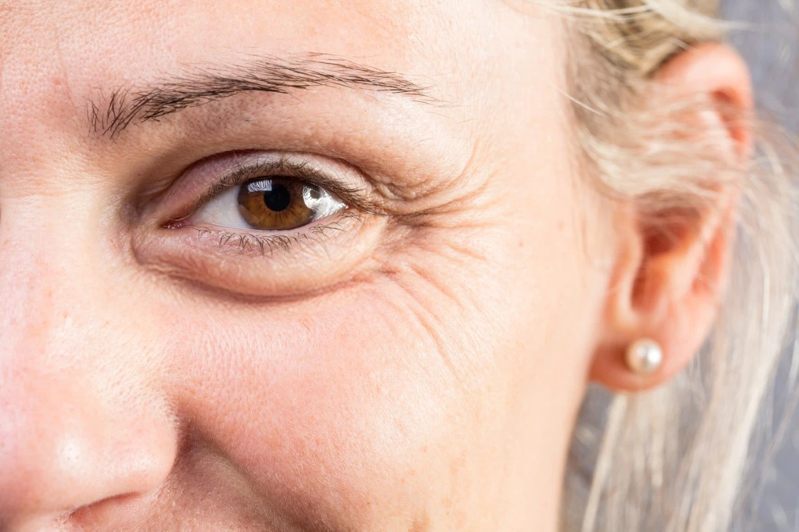 Do glasses help prevent crow's feet?