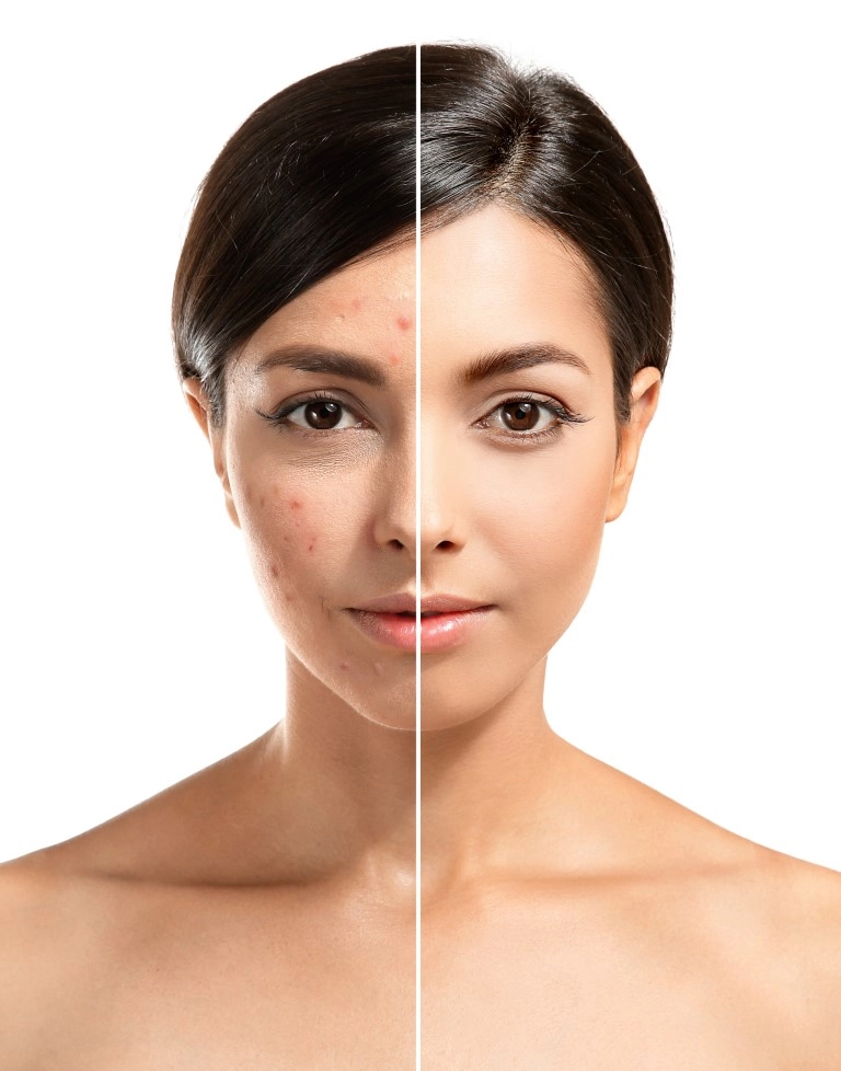 How to Prevent Your Glasses from Causing Acne